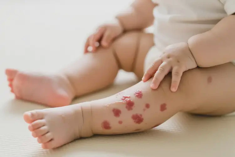 嬰幼兒四肢有濕疹不管它會(huì)自己痊愈嗎(圖3)