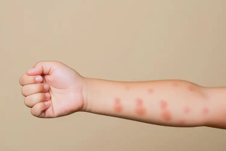 孩子手臂有濕疹不管它會自己自愈嗎(圖4)