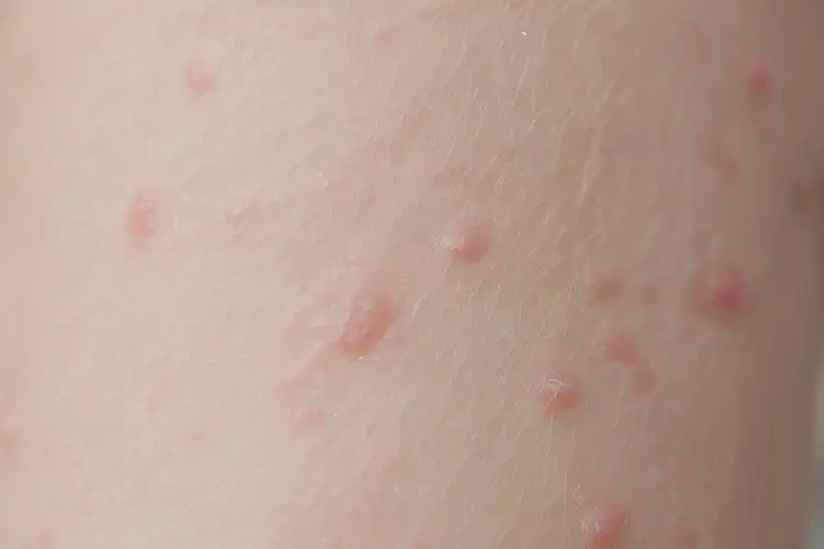 少兒屁股上偶爾長濕疹不管它會自己痊愈嗎(圖4)