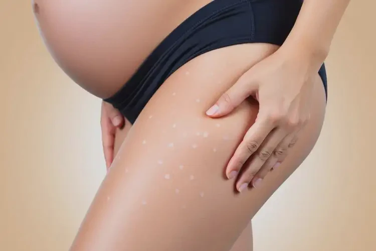 孕婦大腿出濕疹可以徹底自愈嗎(圖3)