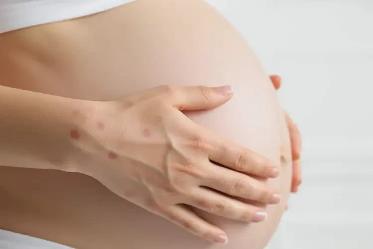 孕婦手上偶爾起濕疹可不可以徹底自愈(圖4)