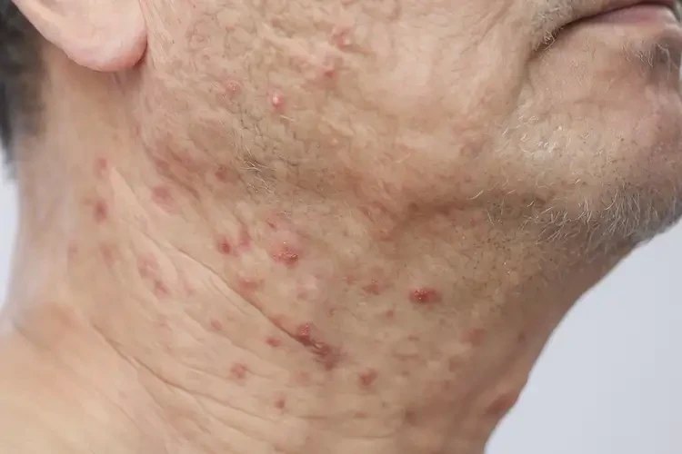 男性脖子容易長濕疹可不可以徹底自愈(圖4)