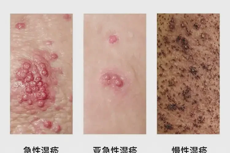 男性肚子上經(jīng)常長(zhǎng)濕疹不管它會(huì)自己痊愈嗎(圖1)