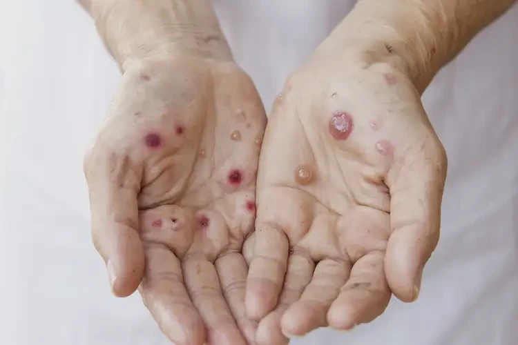 女人手上起濕疹不管它會(huì)自己痊愈嗎(圖4)