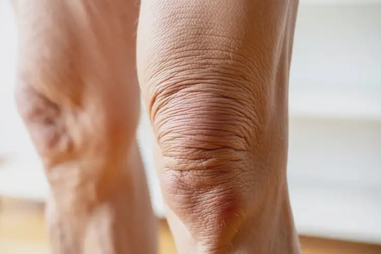 老年人大腿長濕疹不管它會(huì)自己痊愈嗎(圖4)