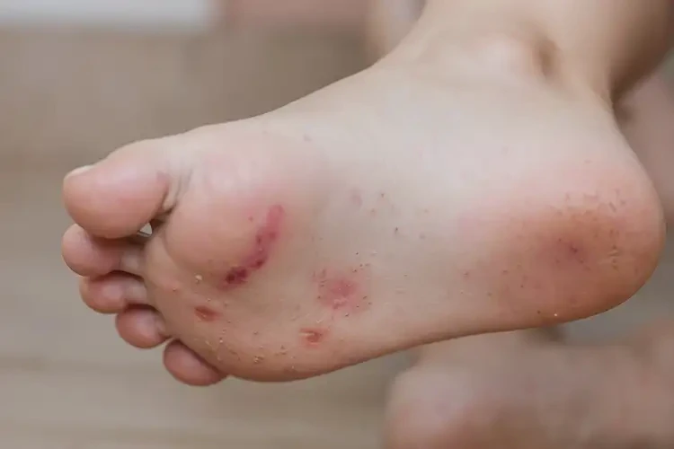 小學(xué)生腳上有濕疹能不能徹底自愈(圖4)