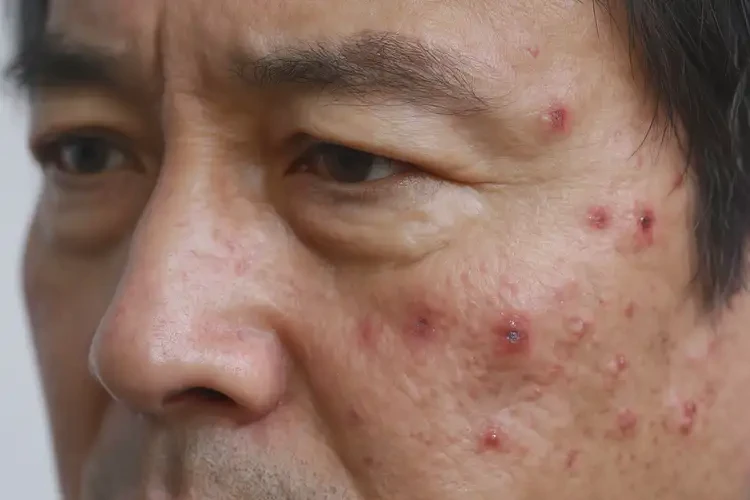 男人屁股上出现湿疹能彻底自愈吗(图4)