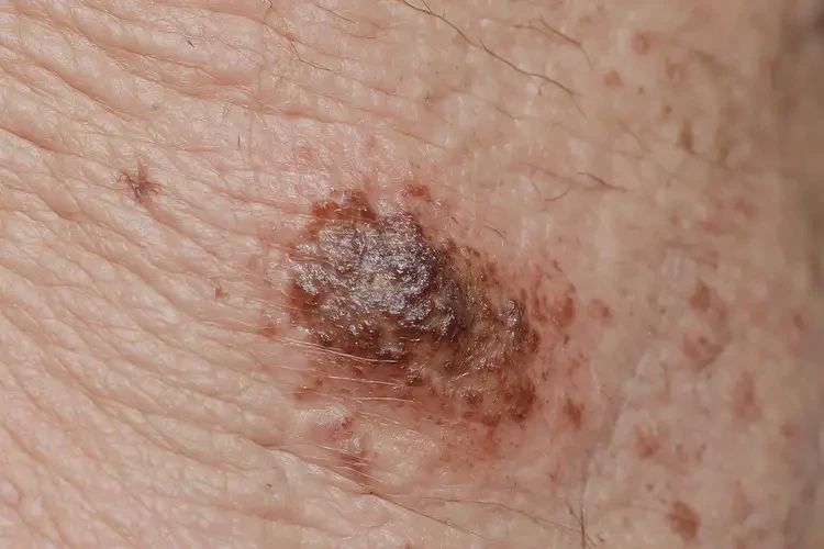 少兒身上起濕疹可以徹底自愈嗎(圖3)