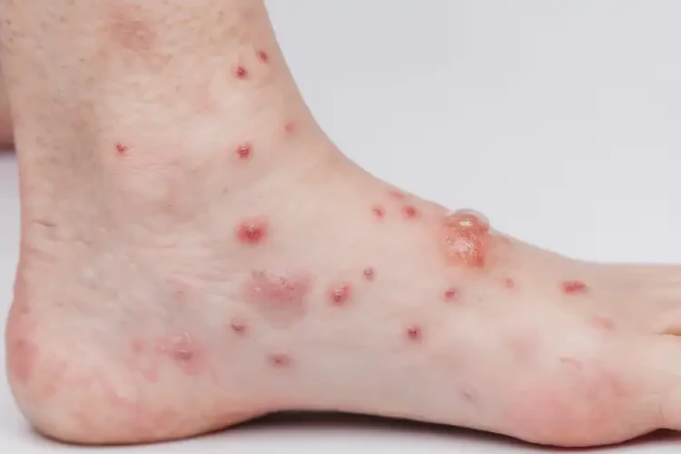 小孩腳上偶爾長濕疹能夠徹底治愈嗎(圖4)