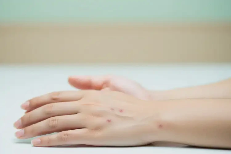 女性身上偶爾起濕疹能徹底自愈嗎(圖3)