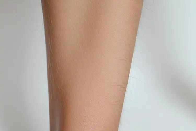 老人小腿上偶爾起濕疹不管它會(huì)自己自愈嗎(圖4)