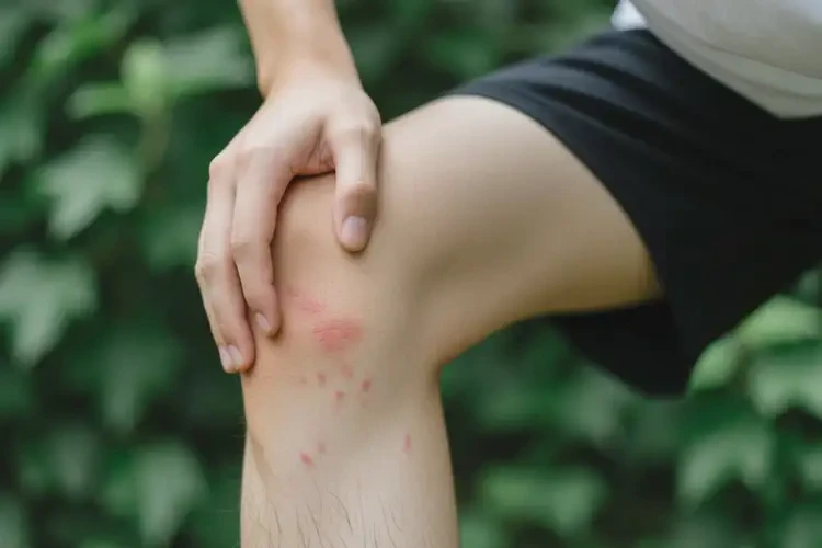 青年人大腿出現(xiàn)濕疹不管它會自己痊愈嗎(圖1)