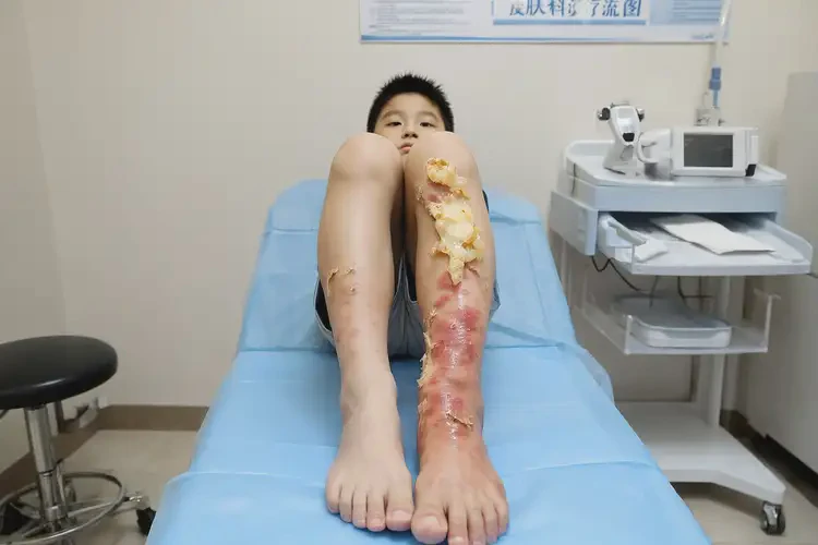 青少年小腿有濕疹能靠自己自愈嗎(圖2)