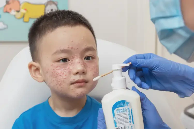 少兒面部容易起濕疹不管它會自己自愈嗎(圖4)