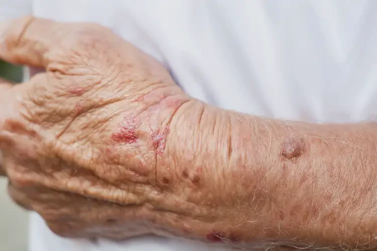 高齡老人手臂上出現(xiàn)濕疹不管它會自己自愈嗎(圖4)