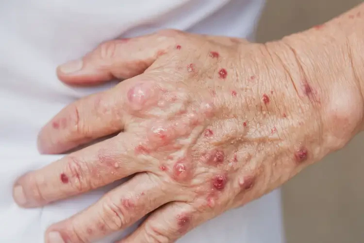 女性身上起濕疹不管它會自己痊愈嗎(圖4)