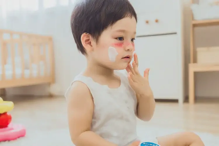 小兒面部出濕疹能靠自己自愈嗎(圖3)