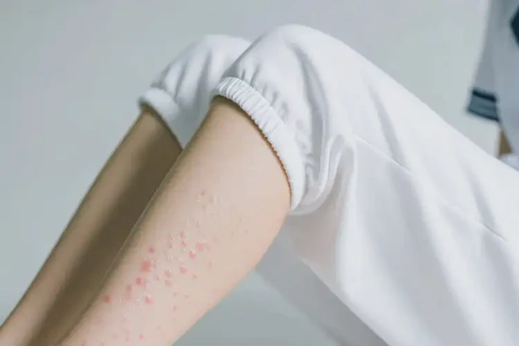 大學(xué)生小腿偶爾長(zhǎng)濕疹不管它會(huì)自己好嗎(圖4)