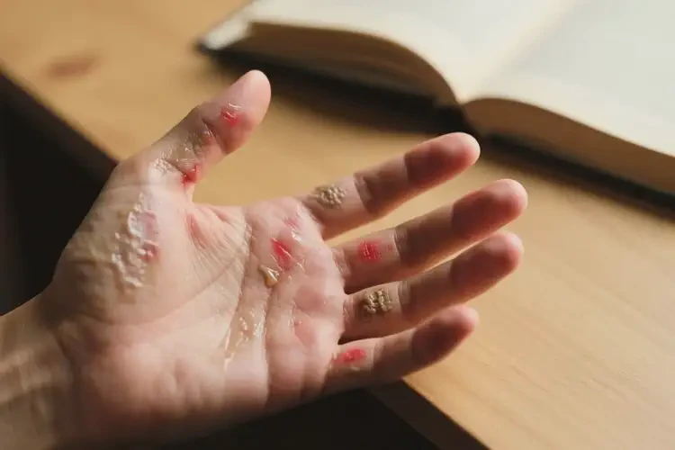 青年人手上有濕疹不管它會自己好嗎(圖2)