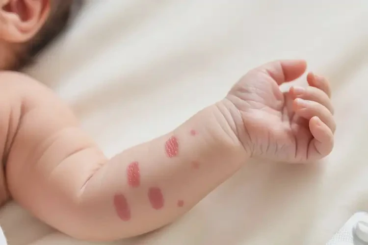 新生兒手臂上容易長濕疹可不可以徹底自愈(圖4)