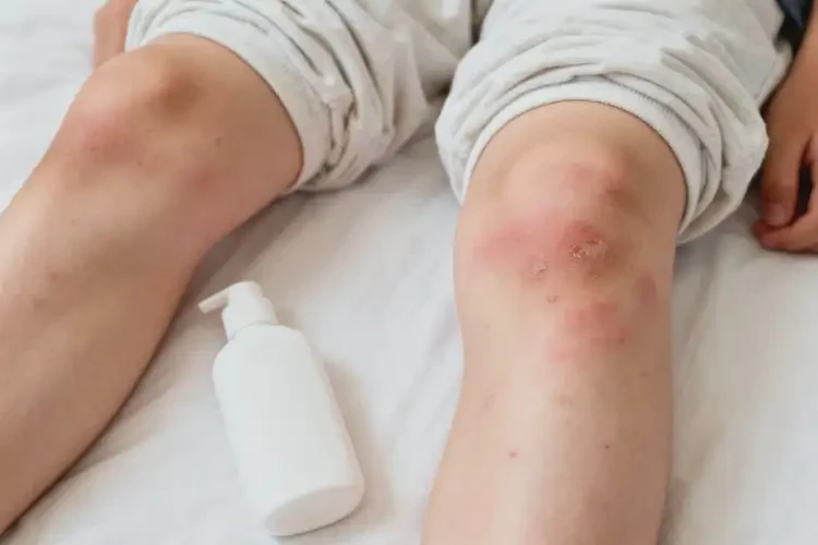 青少年大腿起濕疹可不可以徹底自愈(圖3)