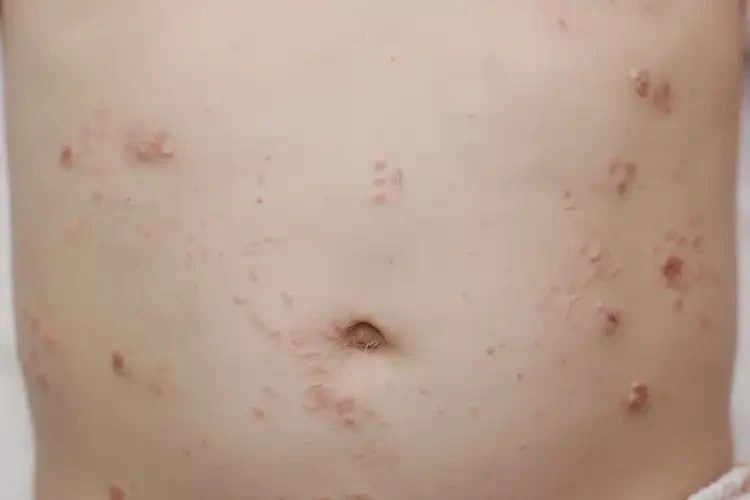 幼兒肚子起濕疹能徹底自愈嗎(圖4)