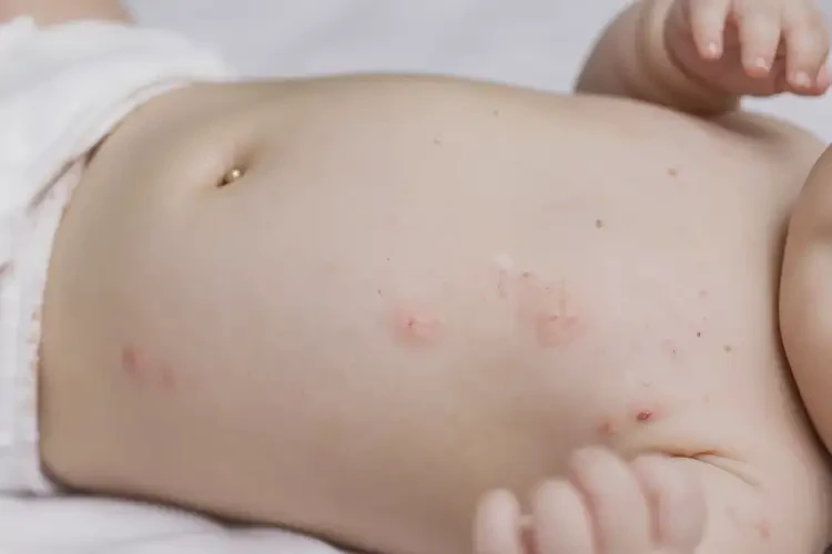 孩子肚子上偶爾起濕疹可以徹底自愈嗎(圖4)