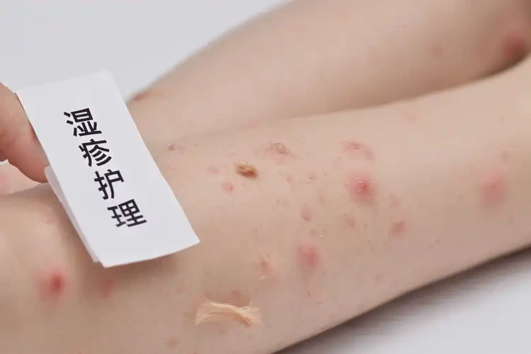 兒童四肢容易起濕疹可不可以徹底自愈(圖4)