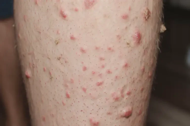 青少年小腿上出現(xiàn)濕疹不管它會(huì)自己自愈嗎(圖4)