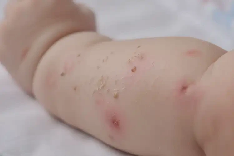 嬰幼兒手臂有濕疹能靠自己自愈嗎(圖4)