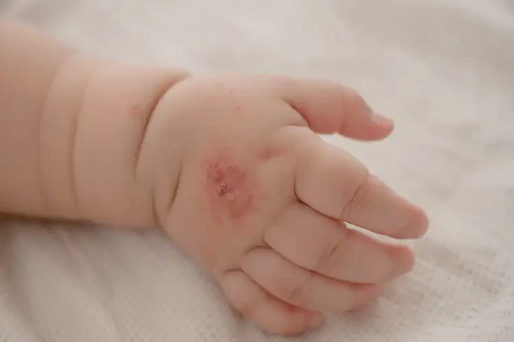寶寶手上起濕疹不管它會(huì)自己好嗎(圖3)