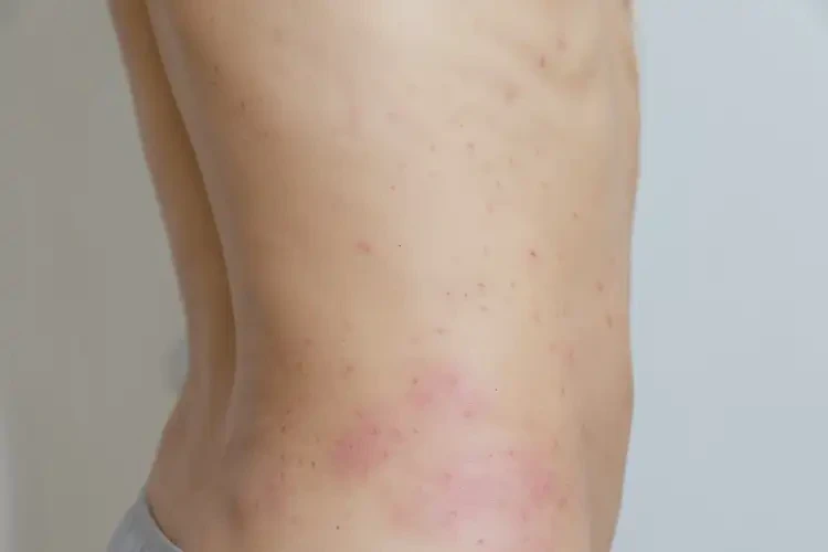 青少年屁股上偶爾長(zhǎng)濕疹可不可以徹底自愈(圖4)