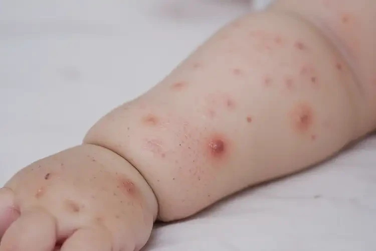 婴幼儿手臂上经常起湿疹不管它会自己痊愈吗(图4)