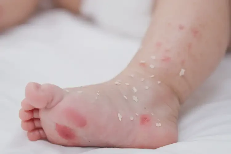 寶寶腳上出濕疹可以徹底自愈嗎(圖4)