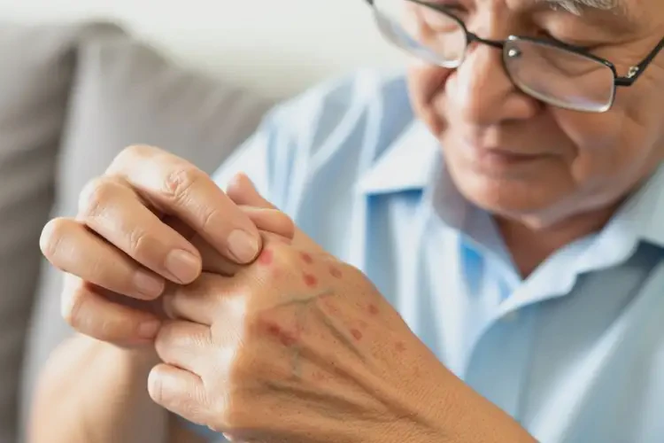 老人手上起濕疹可不可以徹底自愈(圖3)