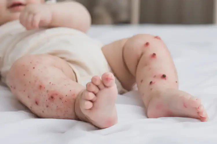 寶寶大腿經(jīng)常起濕疹不管它會自己痊愈嗎(圖4)