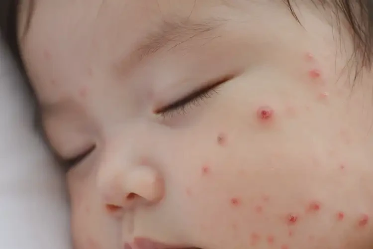 嬰兒身上經(jīng)常長濕疹能徹底自愈嗎(圖4)