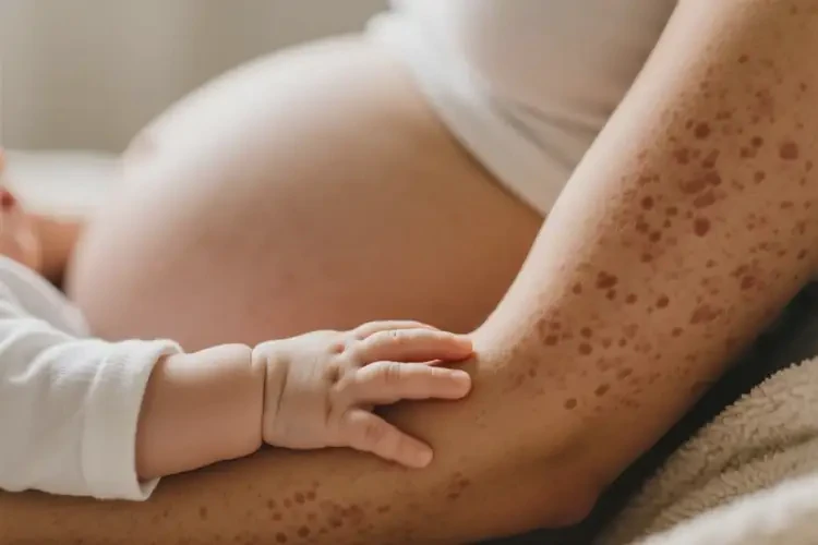 產(chǎn)婦全身出現(xiàn)濕疹可以徹底自愈嗎(圖2)