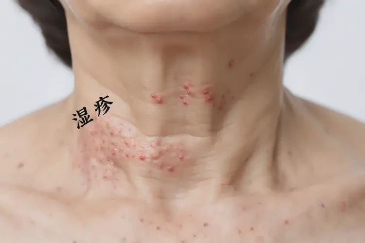 女性脖子有濕疹不管它會(huì)自己痊愈嗎(圖4)