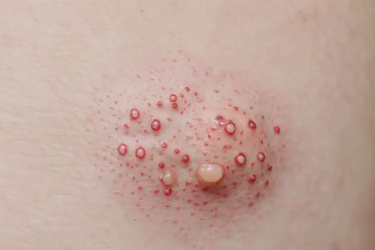 小孩肚子偶爾長濕疹可不可以徹底自愈(圖3)