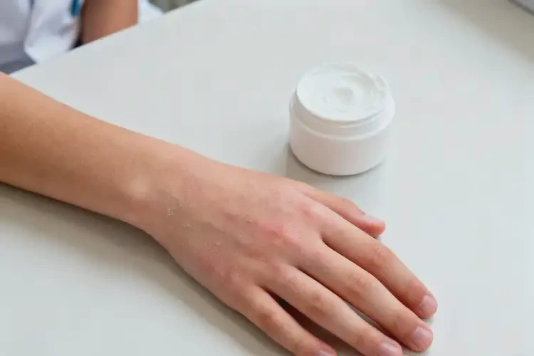 青少年手上容易起濕疹可不可以徹底自愈(圖1)