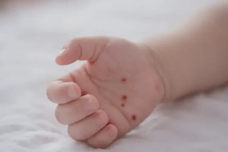 寶寶手上起濕疹不管它會(huì)自己好嗎(圖4)