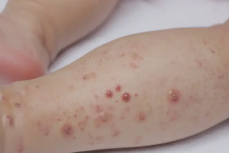 孩子小腿出現(xiàn)濕疹可不可以徹底自愈(圖4)