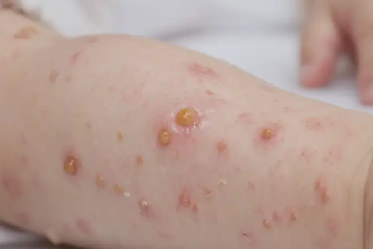 幼兒屁股偶爾長濕疹可以徹底自愈嗎(圖2)