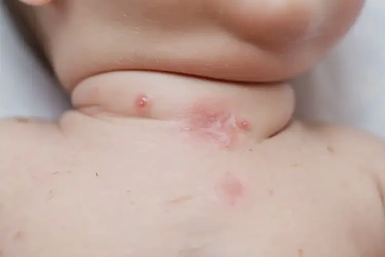 新生兒脖子上起濕疹能徹底自愈嗎(圖4)