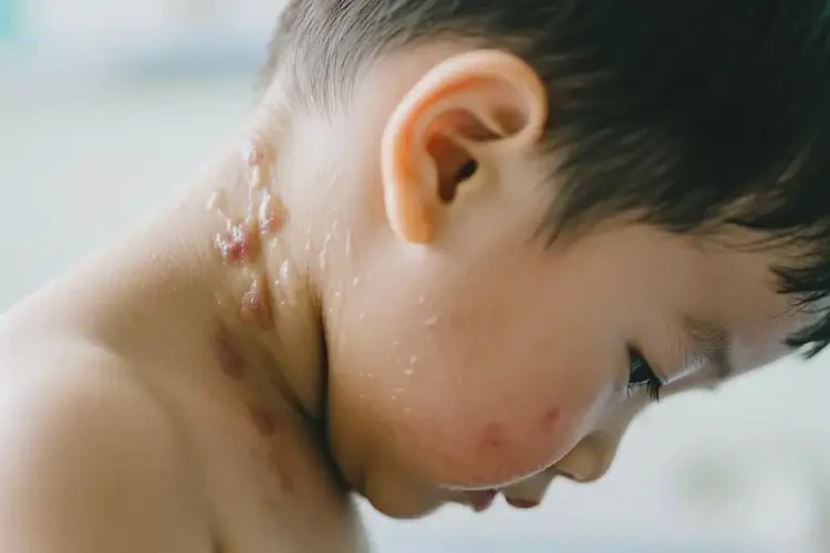 小孩脖子經(jīng)常長濕疹能靠自己自愈嗎(圖3)