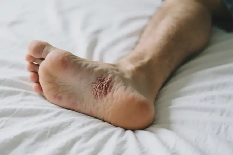 男生腳上偶爾長(zhǎng)濕疹不管它會(huì)自己痊愈嗎(圖1)