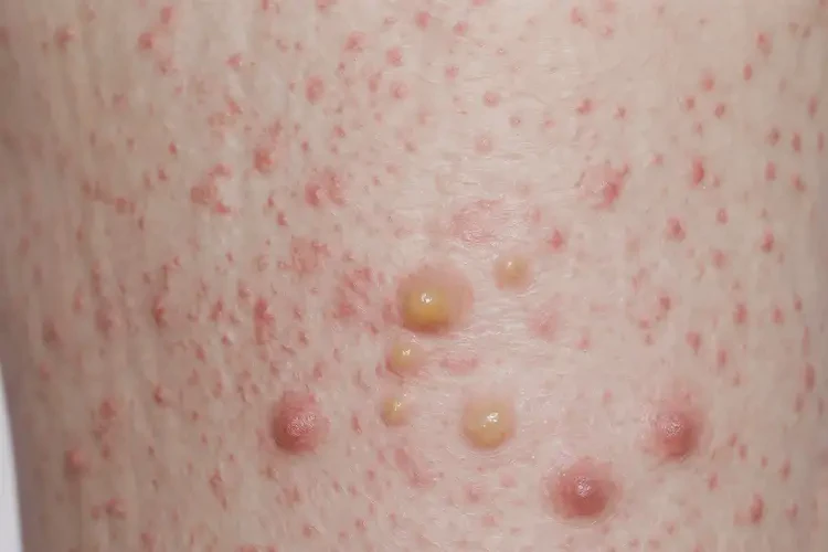 青少年大腿上偶爾起濕疹能靠自己自愈嗎(圖2)