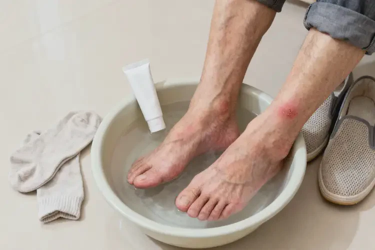 老年人腳上偶爾起濕疹能靠自己自愈嗎(圖4)