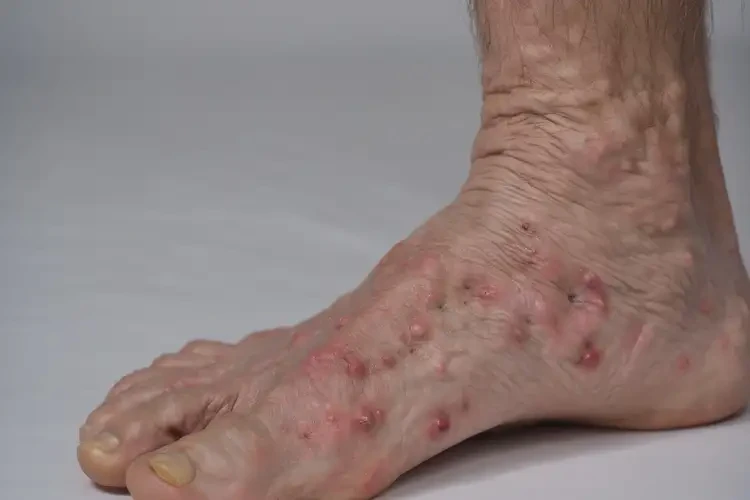 老人腳上經(jīng)常長濕疹不管它會自己自愈嗎(圖4)